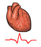EKG-Kurve beim Herzinfarkt